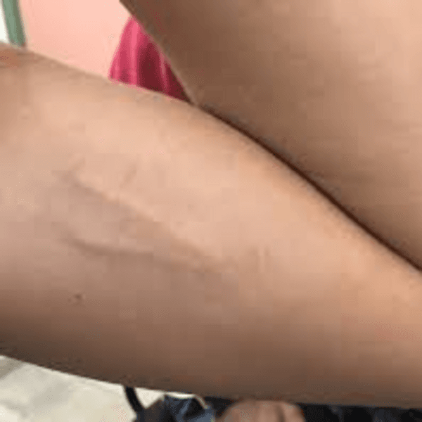 Inserción de Jadelle (Dispositivo incluido)