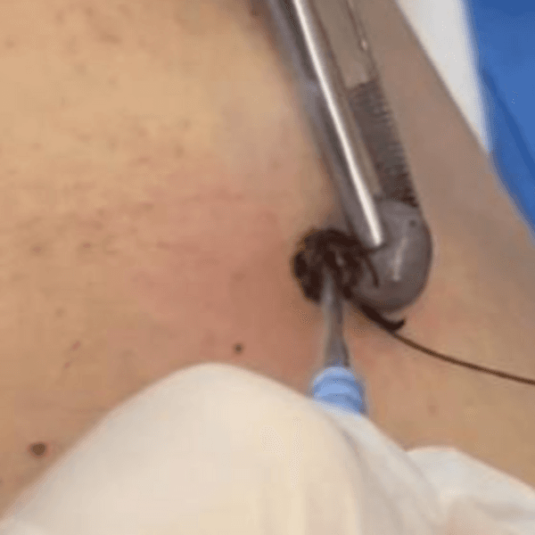 ELECTROCUAGULACION FIBROMAS BLANDOS, NEVO RUBI , QUISTE MILLIUM, ETC (1 A 4 lesiones)