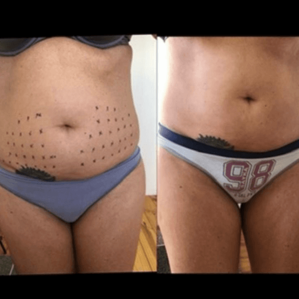 Fosfatidilcolina (tratamiento adiposidad localizada)