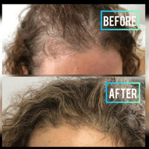 PRP (Capilar) Plasma Rico en Plaquetas ALOPECIA
