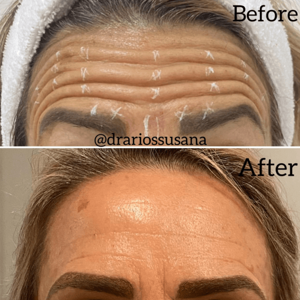 Aplicación de toxina botulínica (BOTOX) 50 UI