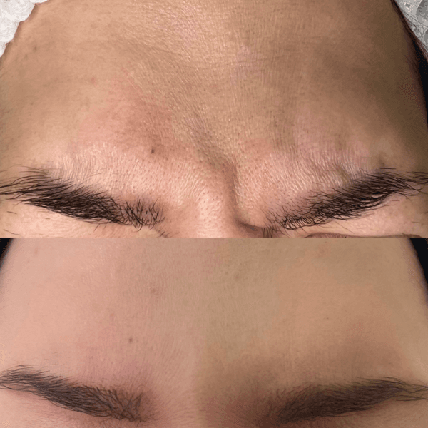 Toxina Botulínica (3 Zonas)