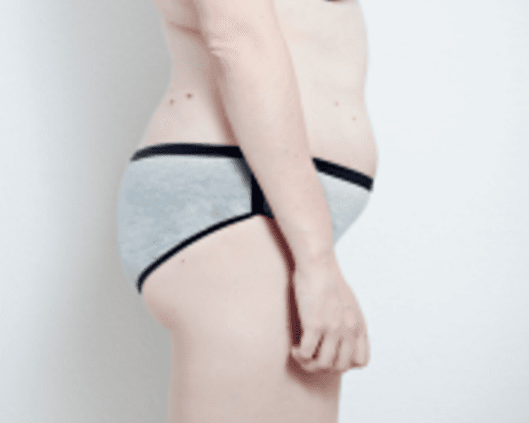 HIFU: Abdomen y flancos (Sesión individual)