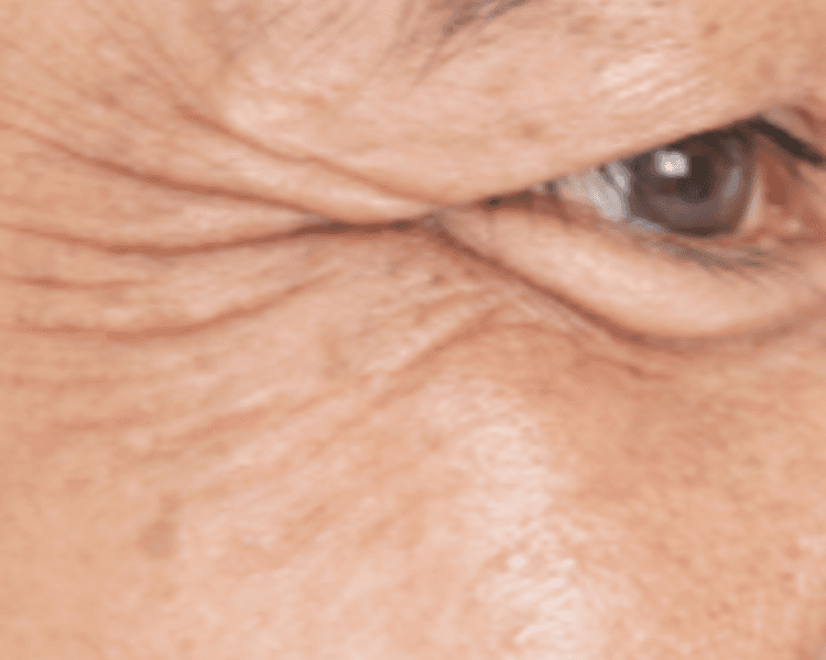 HIFU: Facial y papada (Sesión individual)