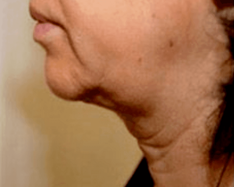 HIFU: Papada (Sesión individual)