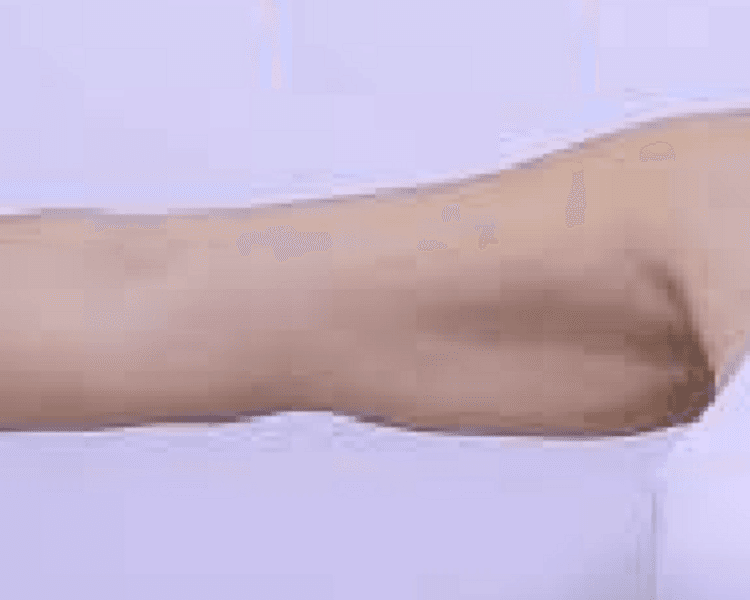 HIFU: Brazos (Sesión individual)