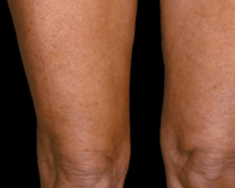 HIFU: Entrepiernas (Sesión individual)