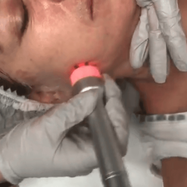 Radio Frecuencia Facial 1 Zona