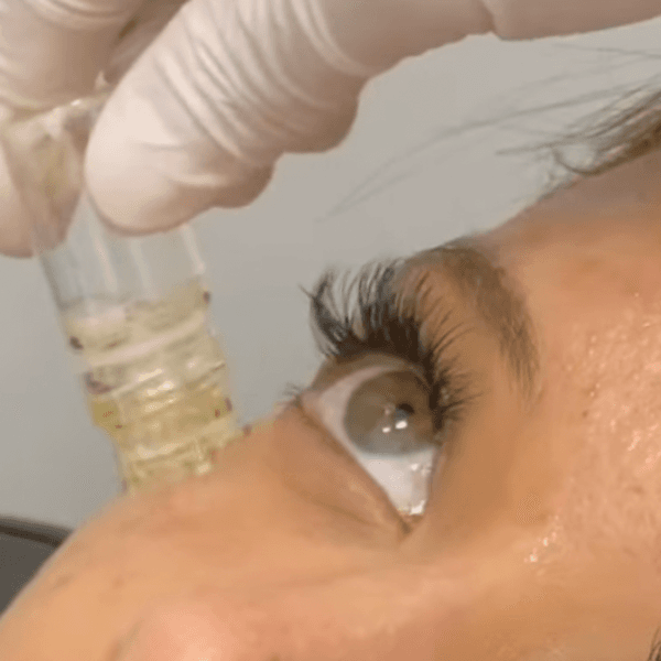 HydraNeedle con Botox