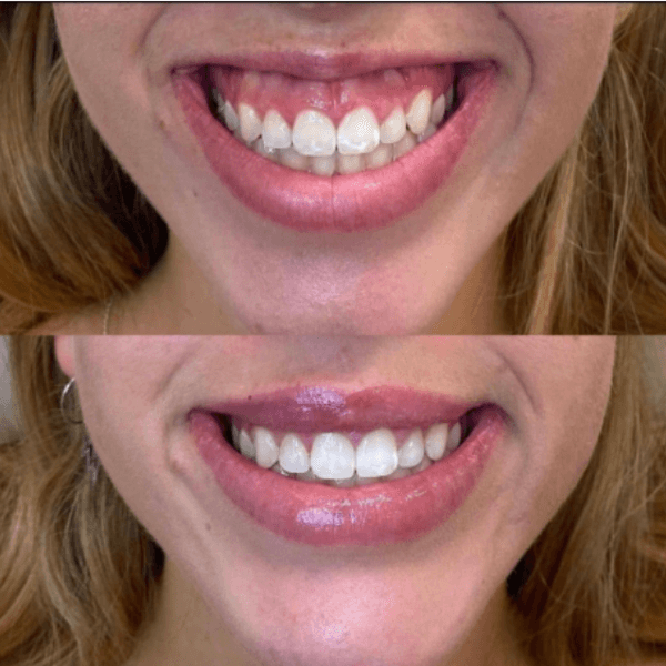 Botox - Sonrisa Gingival