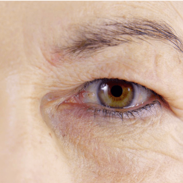 Acupulse- Rejuvenecimiento de Párpados - Bléfarolaser