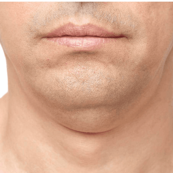 Emerald Láser - Papada - 10 sesiones