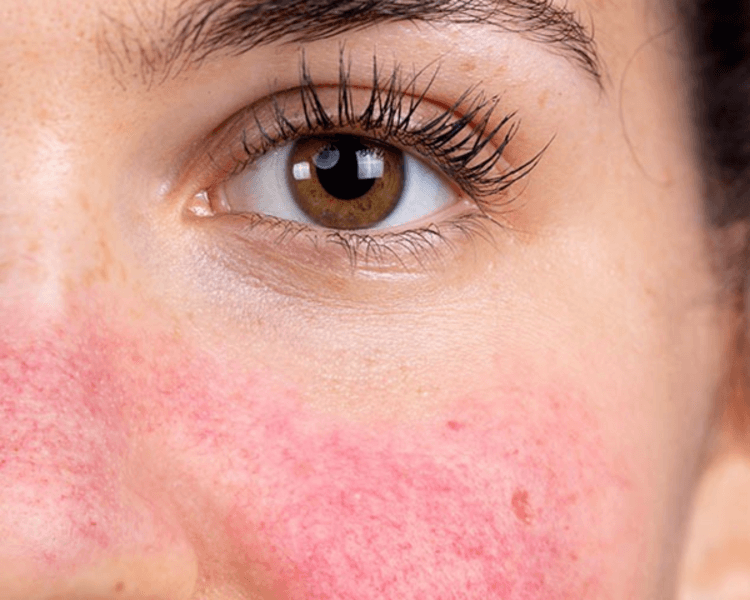 Tratamiento para rosácea