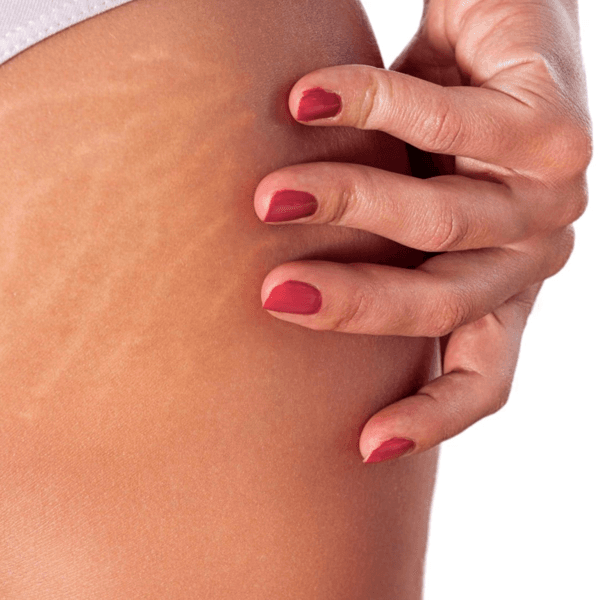 Estrías Bioestimulación (1 zona)