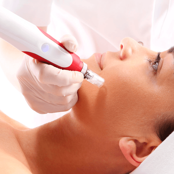 Bioestimulación Dermapen Rostro Completo
