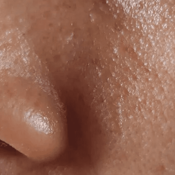 Peeling Azelaico Pieles grasas