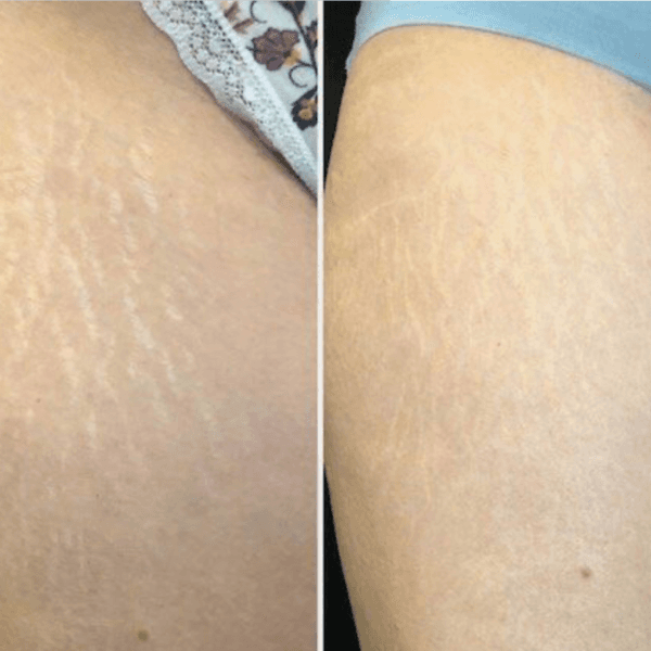 Dermapen para Estrías 💉✨