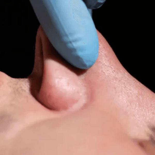 Postoperatorio Rinoplastía