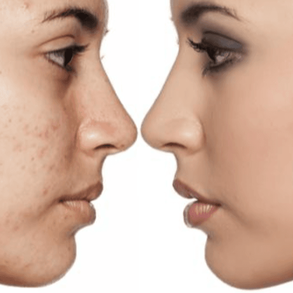 Tratamiento Facial profunda con extracciones