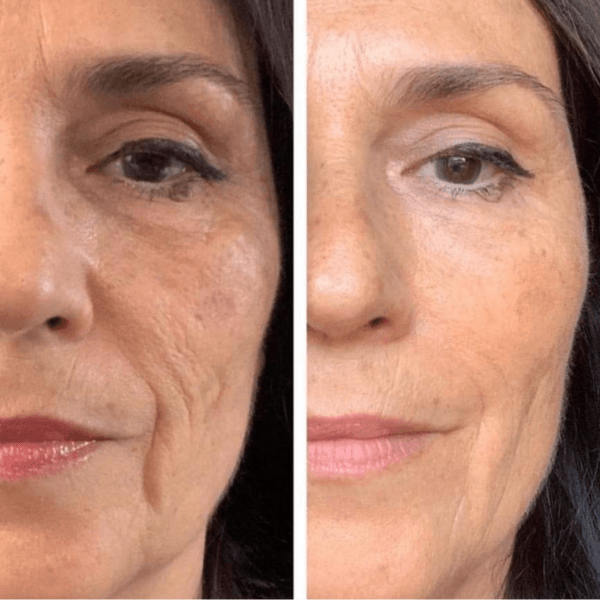 Botox 50 Unidades💉