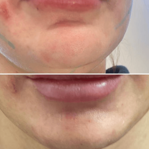 Contorno de Mentón 💉✨