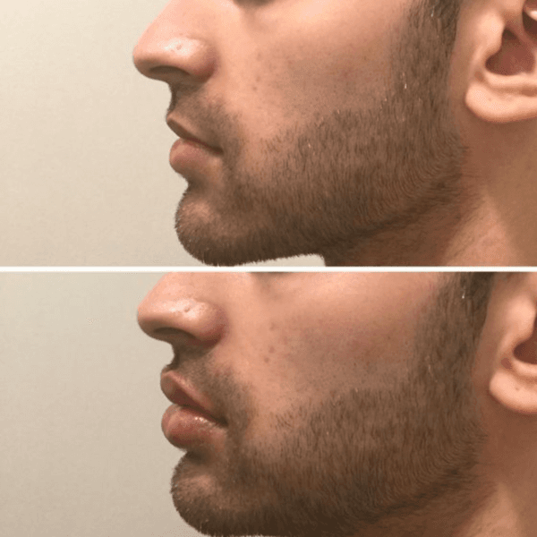 Relleno de Labios 👄