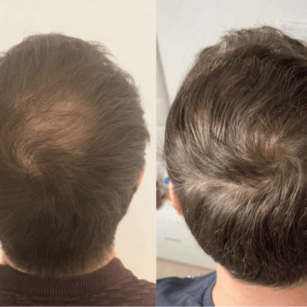 Tratamiento de Crecimiento Capilar con Dermapen y Dutabiot