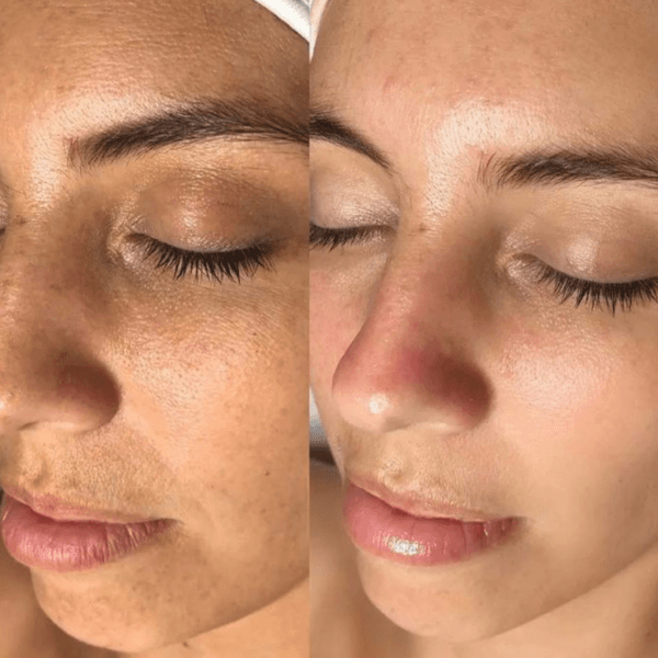 Terapia Plasma (PRP)🌟