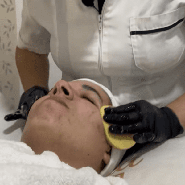 Peeling Químico Cosmiatrico