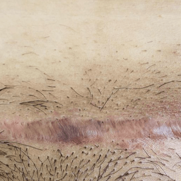 Manejo de cicatrices