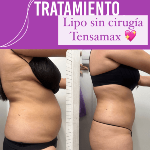 Hidrolipoclasia + Tensamax +Drenaje 1 zona🔆