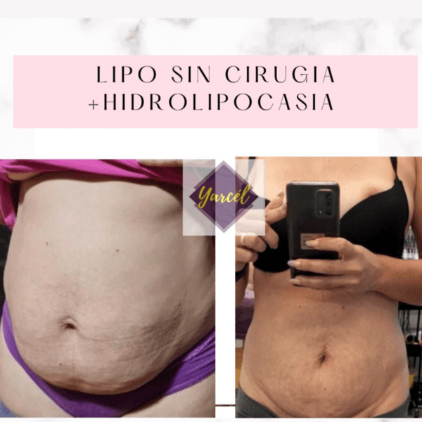 Lipo Sin Cirugia Tensamax🌼