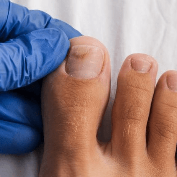 Adicional onicomicosis