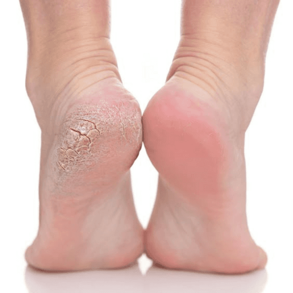 Adicional hiperqueratosis o uñas encarnadas