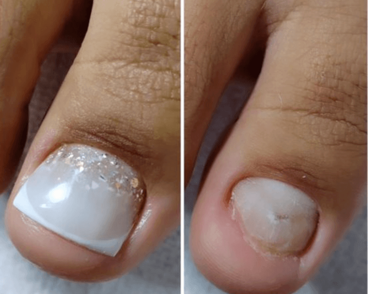 Pedicuría clinica con reconstrucción de uñas (2)