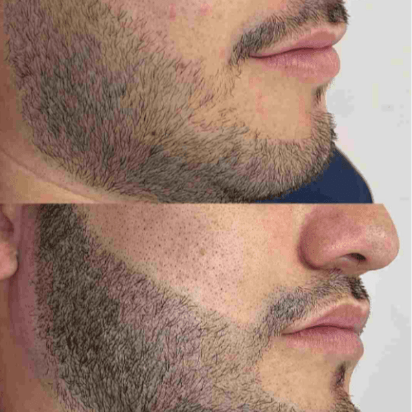 🗂️ MICROPIGMENTACIÓN DE BARBA