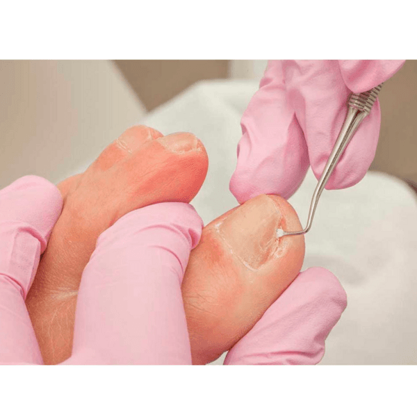 Despiculizacion (extraccion de uña encarnada)