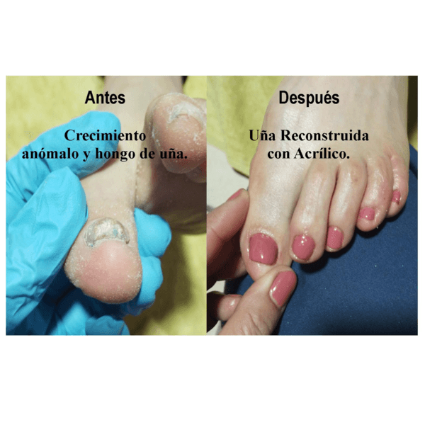 Podologia + reconstrucción de uña con acrílico.