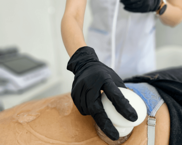 RADIOFRECUENCIA CORPORAL 1 ZONA POR 4 SESIONES