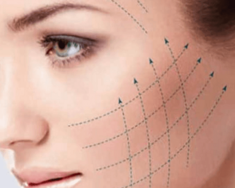 HILOS TENSORES Y PARCHES COSMETOLÓGICOS