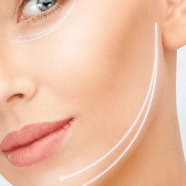 Marcacion Madibular con hilos de tension (4 Hilos)