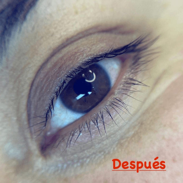 Reversa de lifting y tratamientos con cóctel de botox y vitaminas