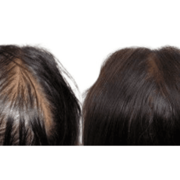 Scalp (Micropigmentacion capilar)