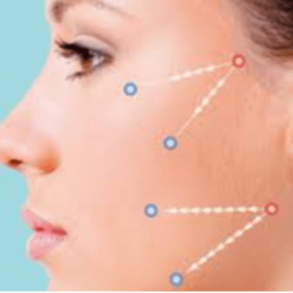 Hilos tensores rostro completo (8 hilos)