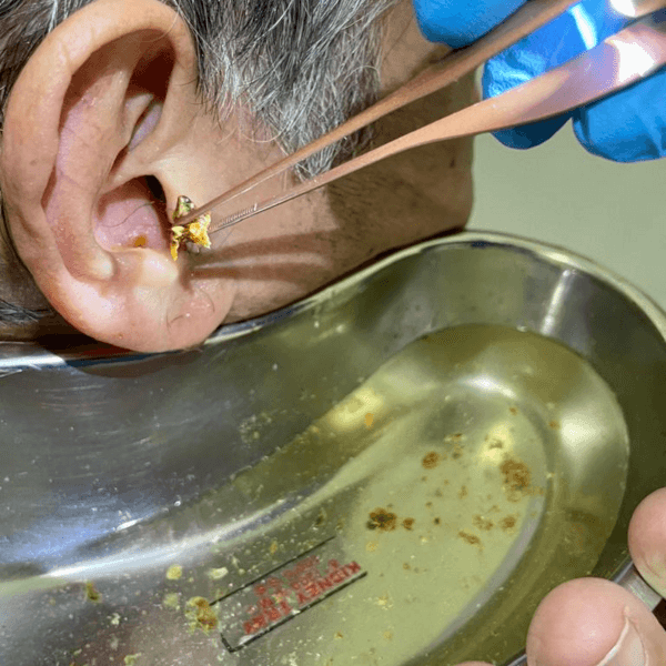 Videotoscopia + Lavado de oídos.