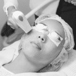 Luz Pulsada (IPL) photo