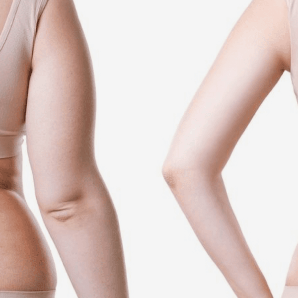 Reducción y tonificación de brazos