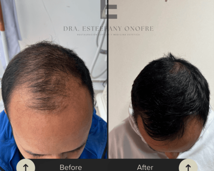 Mesoterapia de Control Hormonal Capilar