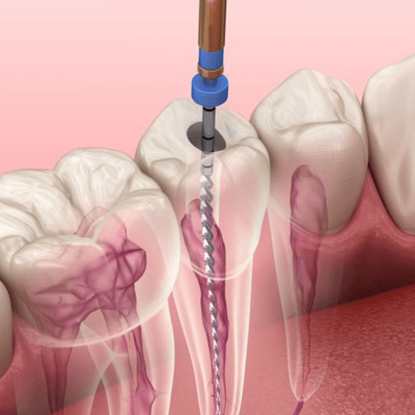 Endodoncia