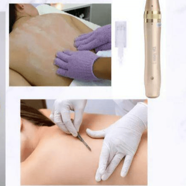 Higiene Profunda en Espalda con Dermaplaning y Dermapen